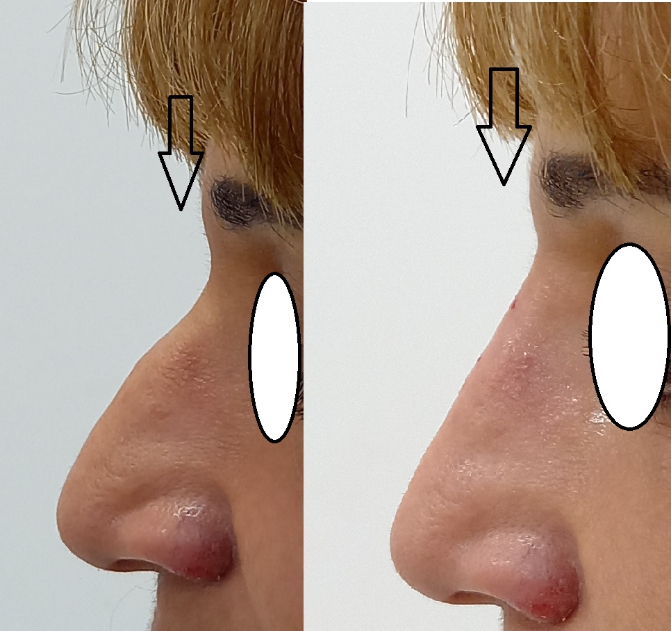 NON SURGICAL RHINOPLASTY.jpg